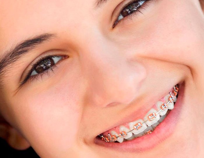 brackets-moda-necesidad