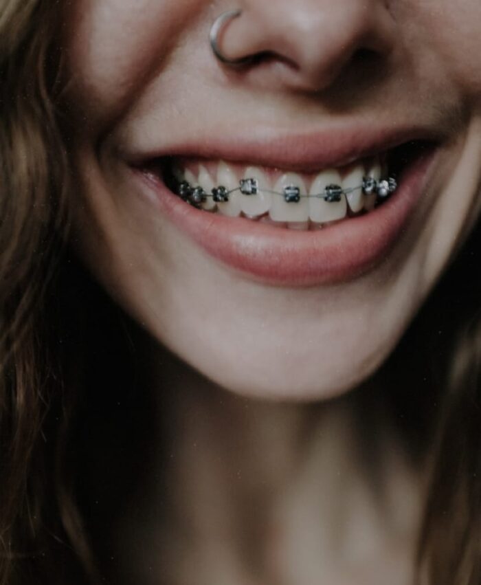 brackets